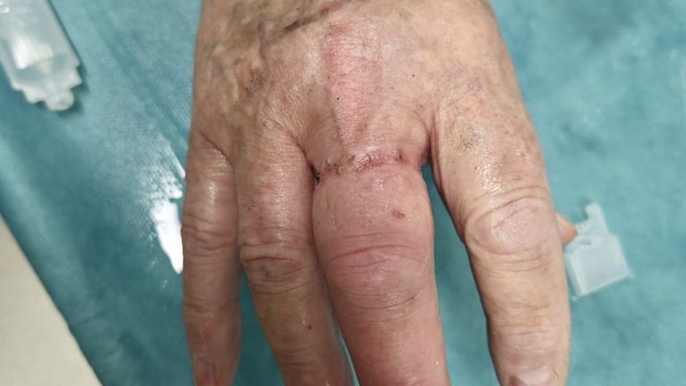 Close-up of an elderly person's hand with a surgical incision on the middle finger, healing with visible scarring.