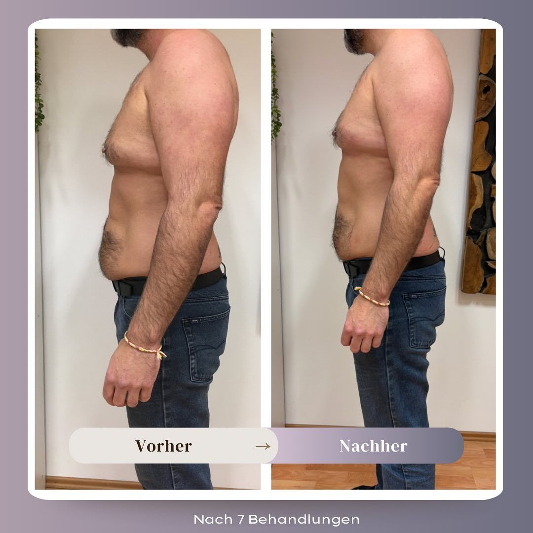 Zwei Bilder zeigen einen Mann vor und nach einer Behandlung. Er hat eine merkliche Veränderung in seiner Körperform, mit reduziertem Körperfett und besser definierten Muskeln. Er trägt blaue Jeans und einen schwarzen Gürtel.