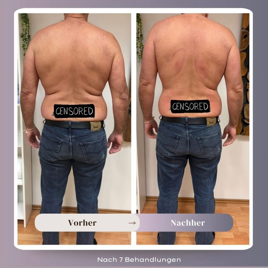 Zwei Bilder des Rückens eines Mannes vor und nach einer Behandlung. Das linke Bild zeigt einen volleren Rücken, während das rechte einen schlankeren Rücken zeigt. Beide Bilder haben 'CENSORED' auf dem Rücken geschrieben.