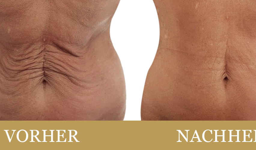Vorher- und nachher-Bilder des Bauchbereichs einer Person, die eine deutliche Reduzierung von Falten und Hautstruktur zeigen.