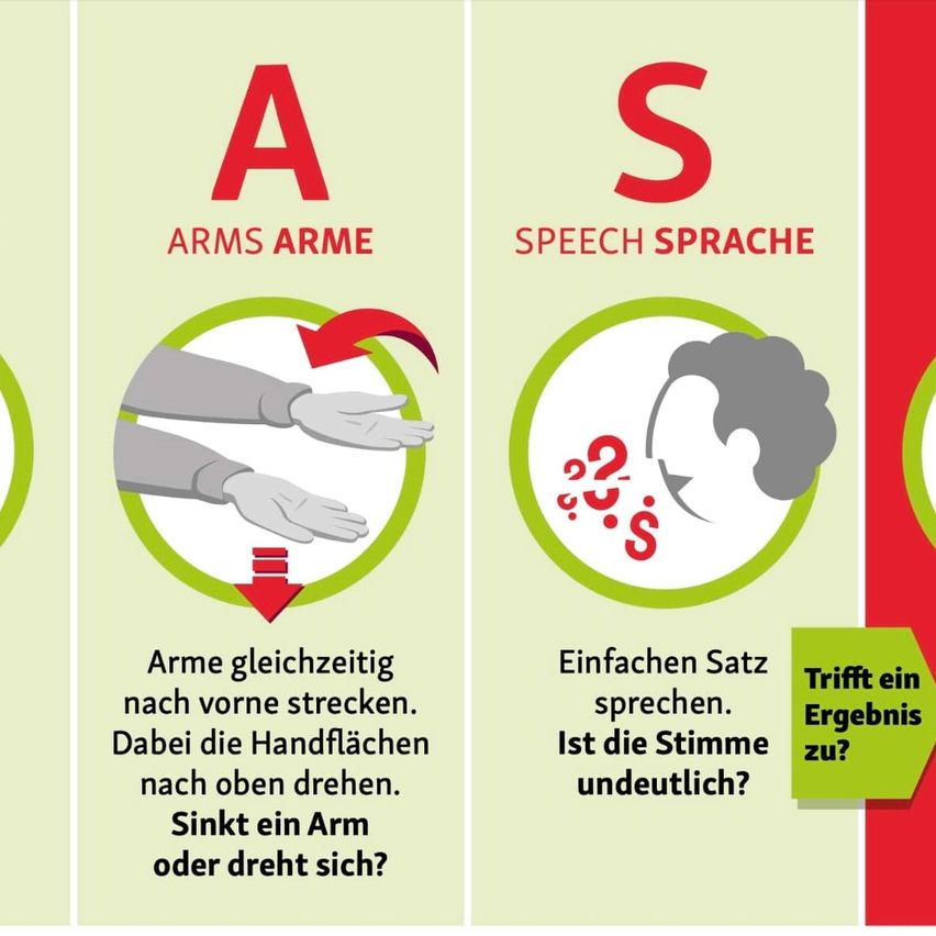 Das Bild zeigt zwei Spalten. Die linke Spalte hat den Buchstaben A und steht für ARMS ARME, mit einer Illustration einer Hand, die sich nach vorne streckt und dreht. Die rechte Spalte hat den Buchstaben S und steht für SPEECH SPRACHE, mit einem Fragezeichen und einer Sprechblase mit dem Buchstaben S. Die Sprechblase fragt, ob die Stimme undeutlich ist.