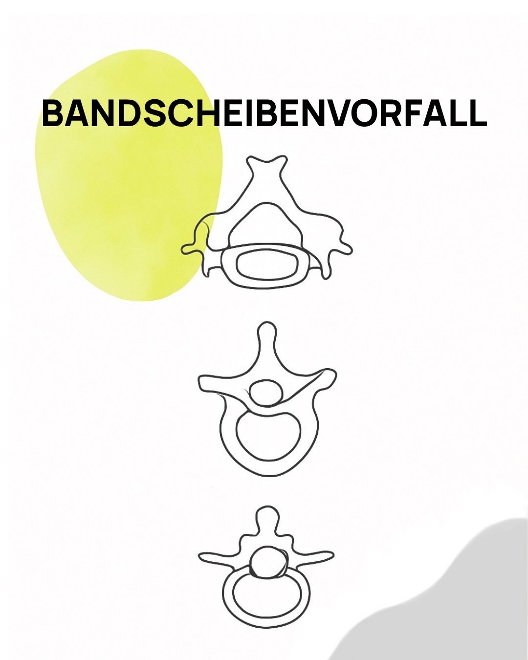 Das Bild zeigt ein Diagramm eines Bandscheibenvorfalls mit drei verschiedenen Stadien der Wirbelsäule. Das erste Stadium ist eine normale Wirbelsäule, gefolgt von einem Stadium mit einem verschobenen Bandscheibenvorfall und schließlich einem Stadium mit einem Bandscheibenvorfall.