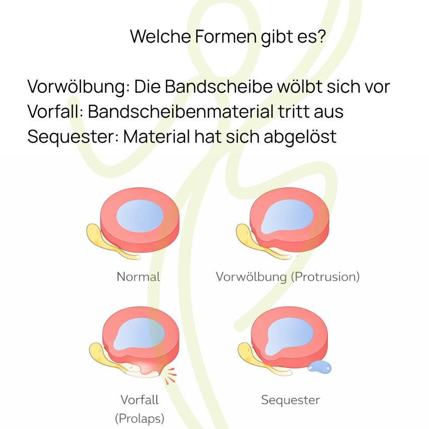 Ein Diagramm zeigt vier verschiedene Zustände eines Bandscheibenvorfalls: normal, Vorwölbung, Vorfall und Sequester. Jeder Zustand ist beschriftet und mit einem Bandscheibenbild illustriert.