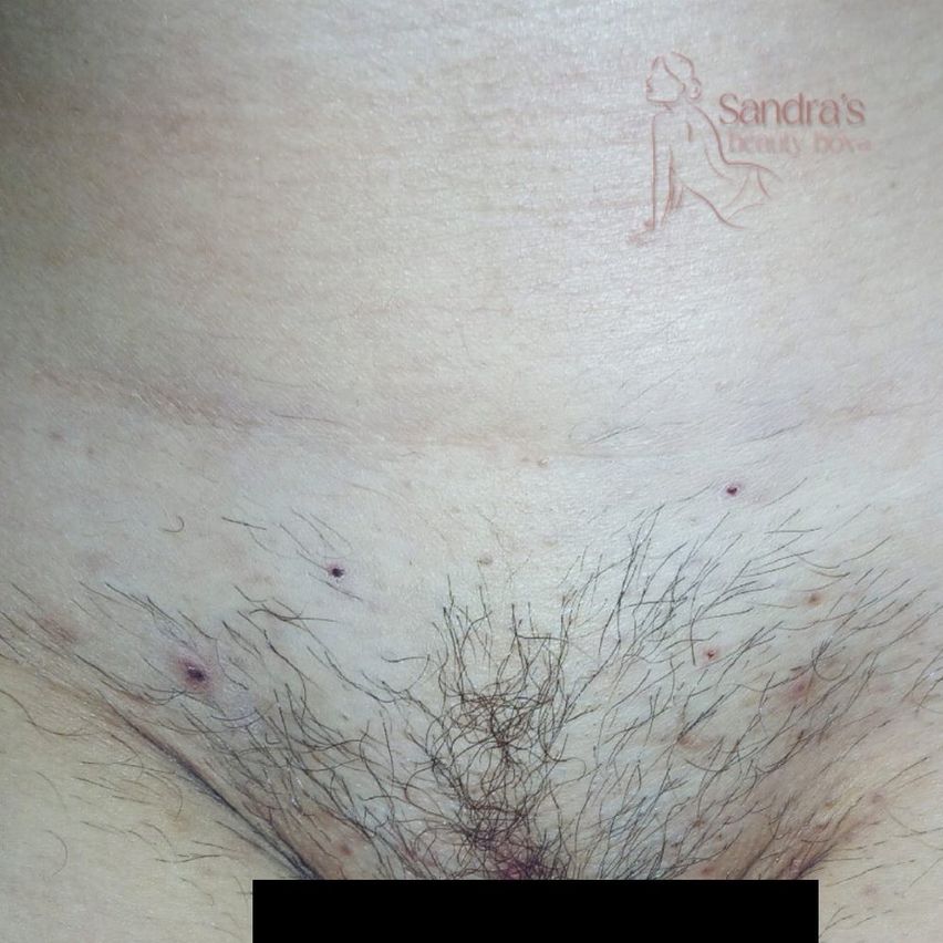 Nahaufnahme der Haut einer Person mit spärlichem Haar und kleinen Punkten, möglicherweise Pickel, in der Nähe der Haarlinie. Ein Wasserzeichen lautet 'Sandra's Beauty Body'.