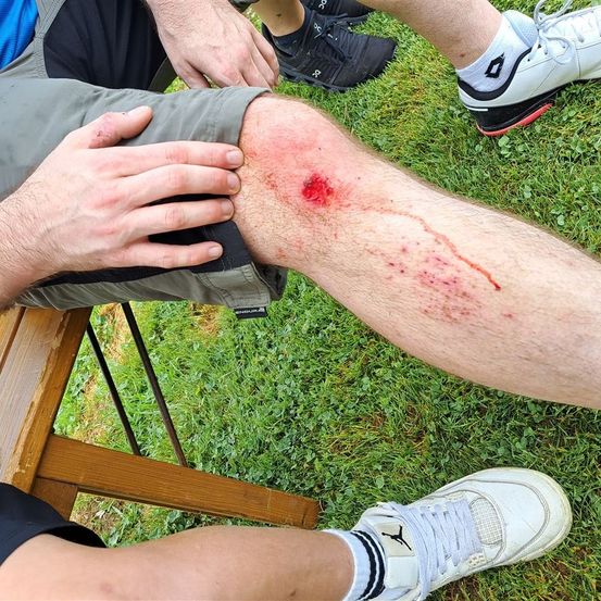 Bild enthält, Injury, Person, Body Part, Knee, Skin, Adult, Male, Man, Footwear, Shoe