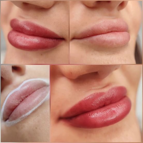 Ein Nahaufnahme-Collage von Frauenlippen vor und nach einer Lippenvergrößerungsbehandlung, die das Auftragen von Lippenfüller und das Endergebnis zeigt.