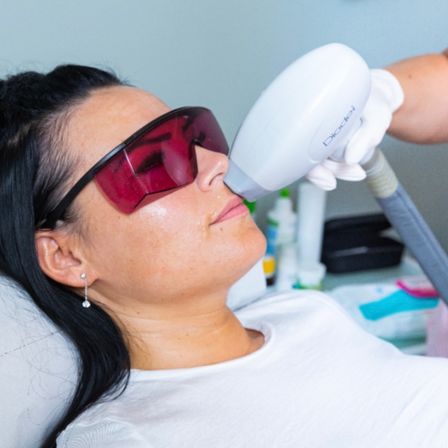Eine Frau mit dunklen Haaren trägt Schutzbrillen, während sie eine Laserbehandlung im Gesicht erhält.