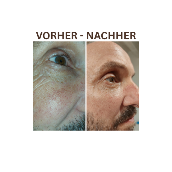 Vorher-Nachher-Bilder zeigen das Gesicht einer Person mit deutlichen Verbesserungen der Hauttextur und des Aussehens.