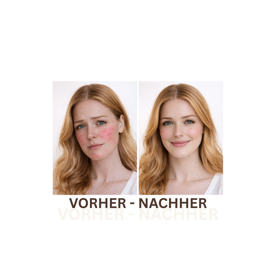 Das Gesicht einer Frau wird vor und nach der Behandlung mit roten Flecken und dann klarer Haut gezeigt.