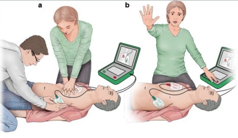 Eine Illustration, die zeigt, wie eine Person einen Defibrillator an einem auf dem Boden liegenden Mann benutzt, wobei eine andere Person hilft.