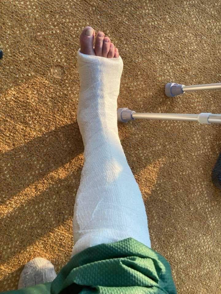 Ein Fuß mit einem weißen Verband, der auf einem Teppichboden ruht. Ein Paar Krücken liegt neben dem Fuß.