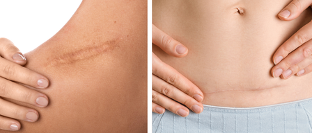 Two images of a person's abdomen, one showing a scar from a surgical procedure and the other with a hand touching a scar.