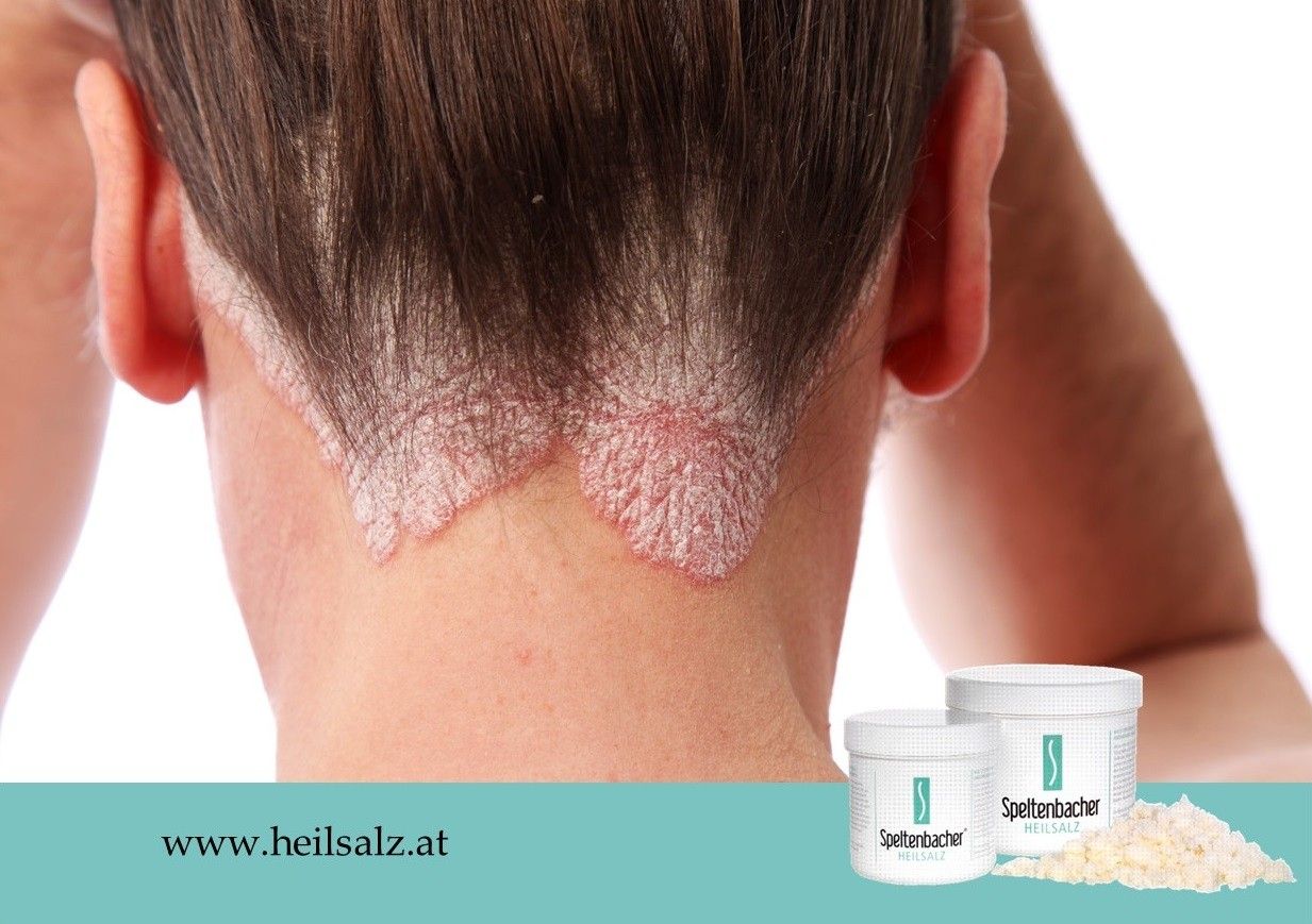 Ein Nahaufnahme der Kopfhaut einer Person mit sichtbaren Psoriasis-Flecken. Unten befinden sich zwei Behälter mit 'Speltenbacher Heilsalz'.