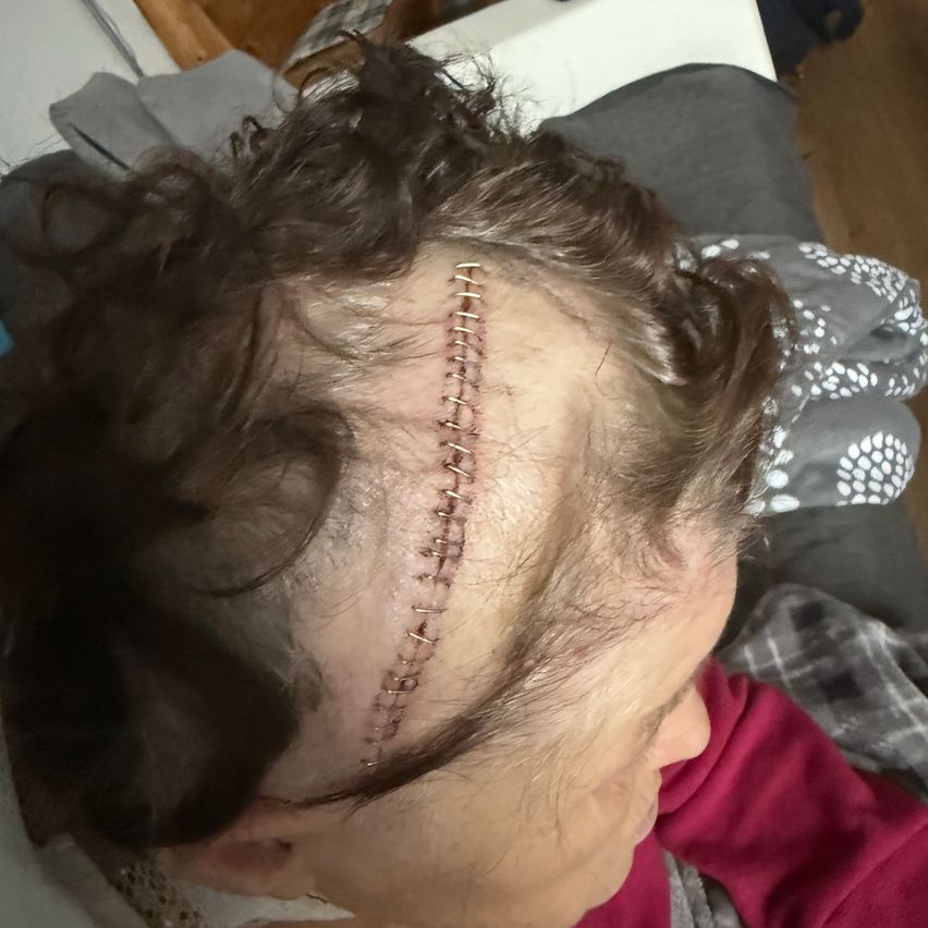 Nahaufnahme des Kopfes einer Person mit einer sichtbaren chirurgischen Narbe, die von der Stirn bis zur Haarlinie verläuft.