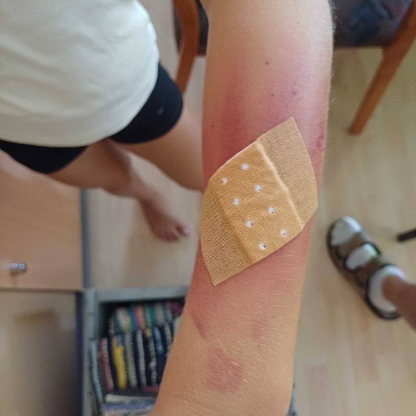 Der Arm einer Person mit einem Pflaster, das einen gerötete Bereich bedeckt, möglicherweise ein Bluterguss. In der Nähe sind ein Fuß in Sandalen und ein Holzstuhl zu sehen.