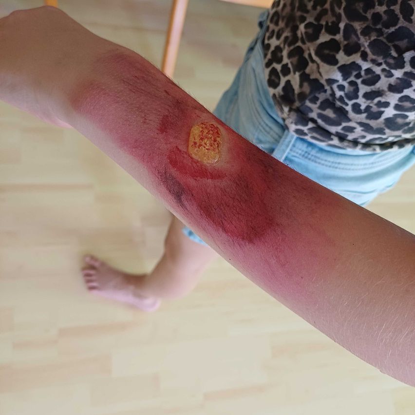 Ein Nahaufnahme von einem Arm zeigt einen blauen Fleck mit einem gelben Zentrum, was auf eine heilende Wunde hinweist.