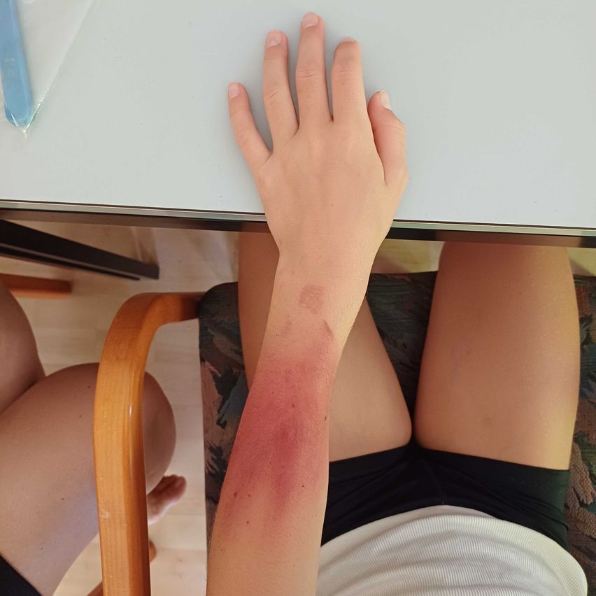Eine Person mit einer geröteteten und gereizten Stelle am Unterarm, die an einem Schreibtisch sitzt.