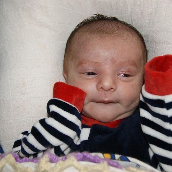 Ein Baby mit einem roten Ausschlag im Gesicht, das ein rot-weiß gestreiftes Langarmshirt trägt, liegt auf einem weißen Kissen.