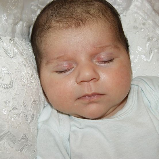 Ein Baby schläft friedlich auf einem weißen Spitzenkissen mit einem leichten roten Fleck auf dem linken Auge.